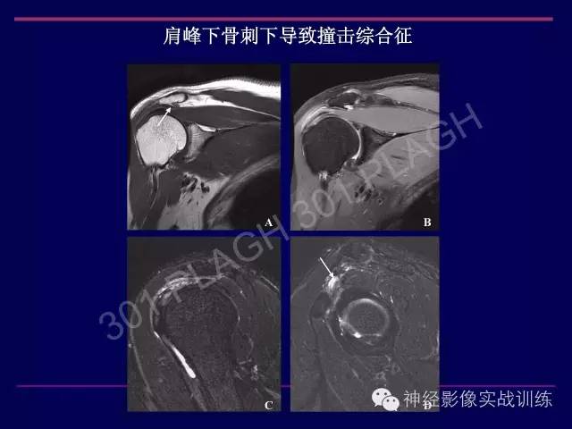 【PPT】肩关节撞击综合征的磁共振诊断
