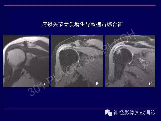 【PPT】肩关节撞击综合征的磁共振诊断