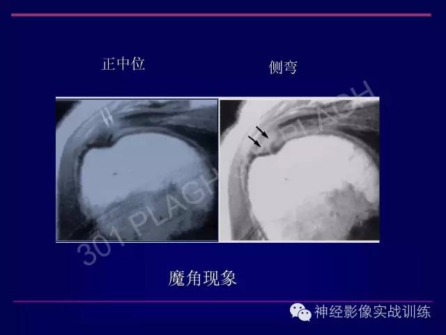 【PPT】肩关节撞击综合征的磁共振诊断