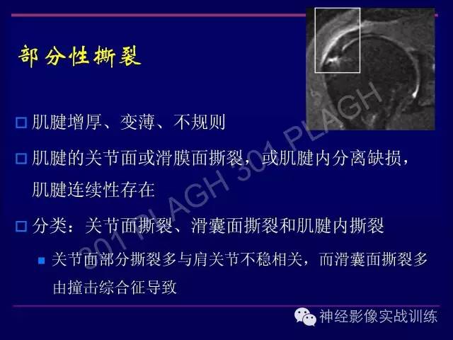 【PPT】肩关节撞击综合征的磁共振诊断