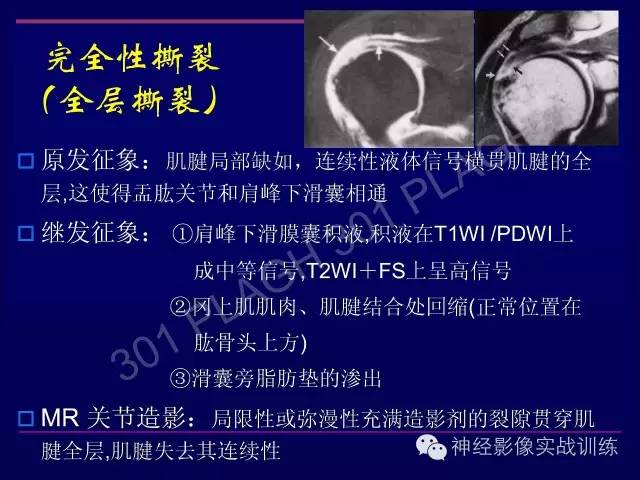 【PPT】肩关节撞击综合征的磁共振诊断