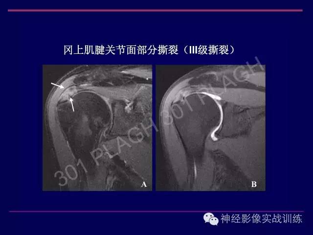 【PPT】肩关节撞击综合征的磁共振诊断