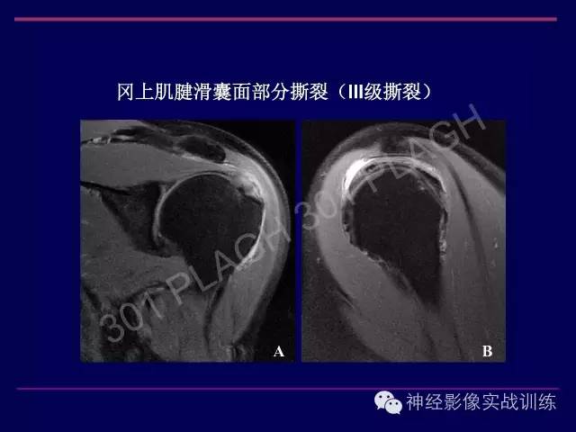 【PPT】肩关节撞击综合征的磁共振诊断