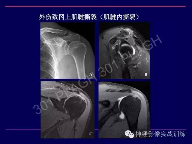 【PPT】肩关节撞击综合征的磁共振诊断