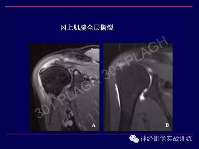 【PPT】肩关节撞击综合征的磁共振诊断