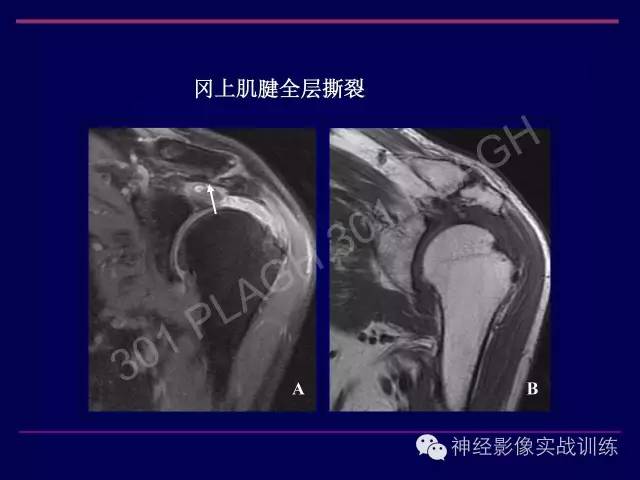 【PPT】肩关节撞击综合征的磁共振诊断