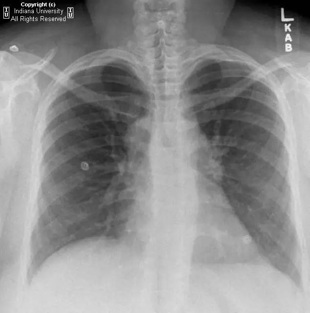 【病例】中央导管血栓所致上腔静脉阻塞1例CT 【病例】中央导管血栓所致上腔静脉阻塞1例CT