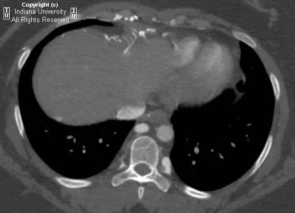 【病例】中央导管血栓所致上腔静脉阻塞1例CT 【病例】中央导管血栓所致上腔静脉阻塞1例CT