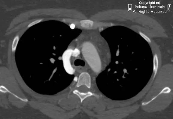 【病例】中央导管血栓所致上腔静脉阻塞1例CT 【病例】中央导管血栓所致上腔静脉阻塞1例CT