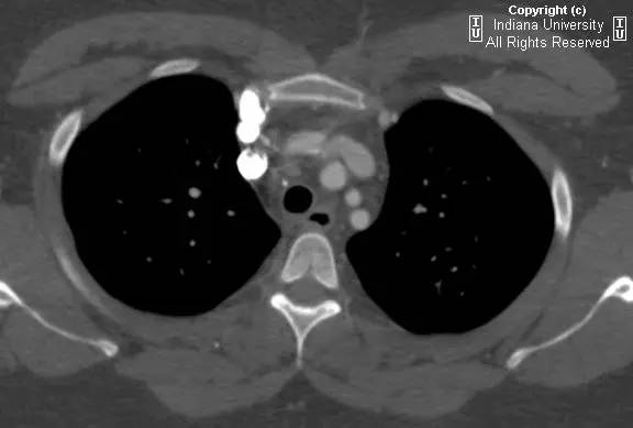【病例】中央导管血栓所致上腔静脉阻塞1例CT 【病例】中央导管血栓所致上腔静脉阻塞1例CT