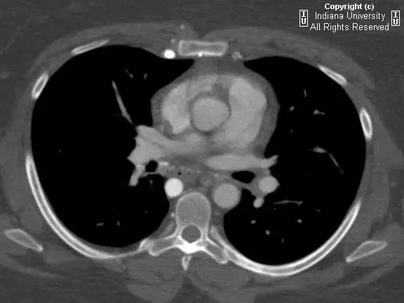 【病例】中央导管血栓所致上腔静脉阻塞1例CT 【病例】中央导管血栓所致上腔静脉阻塞1例CT