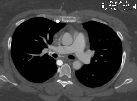 【病例】中央导管血栓所致上腔静脉阻塞1例CT 【病例】中央导管血栓所致上腔静脉阻塞1例CT