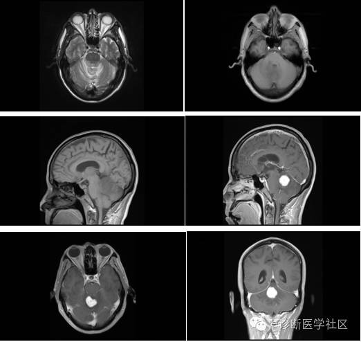 【病例】四脑室脉络丛乳头状瘤1例MR 【病例】四脑室脉络丛乳头状瘤1例MR