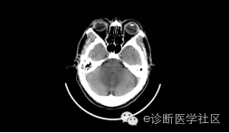 【病例】四脑室脉络丛乳头状瘤1例MR 【病例】四脑室脉络丛乳头状瘤1例MR