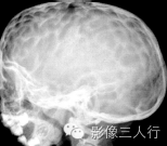 "钢盔征"，这个征象提示啥？