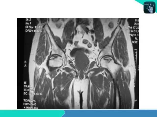 【PPT】股骨头缺血性坏死