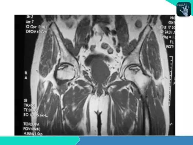 【PPT】股骨头缺血性坏死