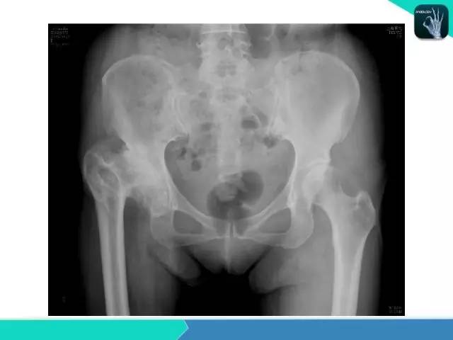 【PPT】股骨头缺血性坏死