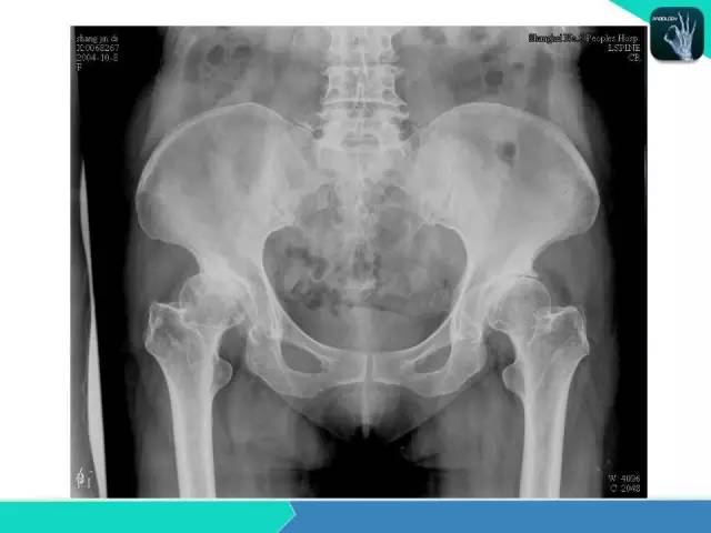 【PPT】股骨头缺血性坏死