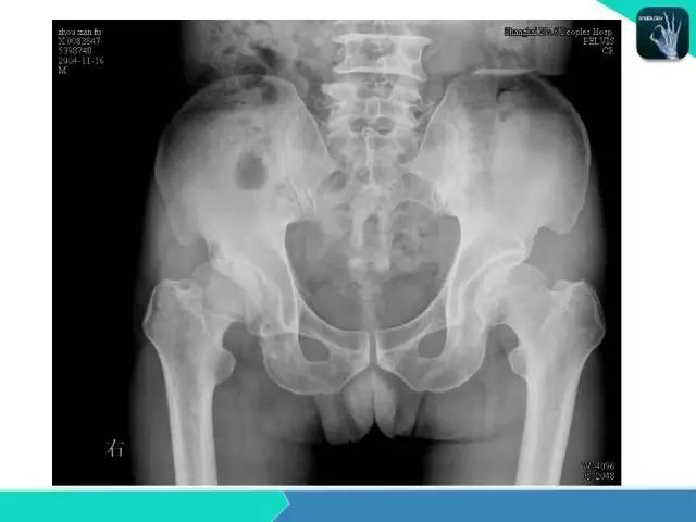【PPT】股骨头缺血性坏死
