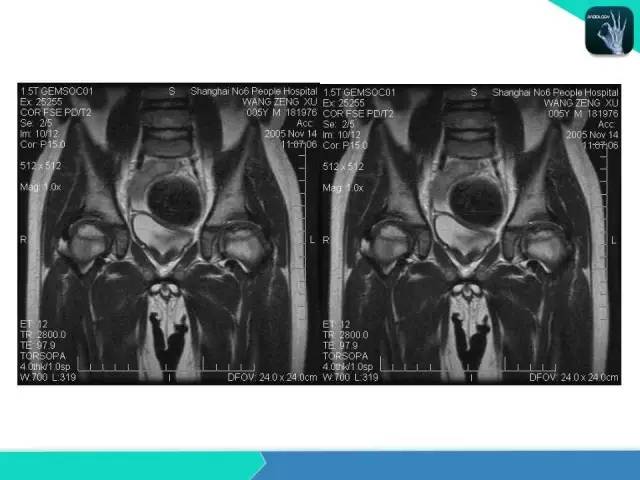 【PPT】股骨头缺血性坏死