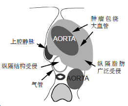 原发性肺部肿瘤的可切除性:影像学评估 原发性肺部肿瘤的可切除性:影像学评估