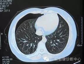 气胸量怎样评估？