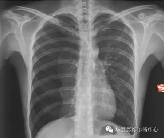 气胸量怎样评估? 气胸量怎样评估?