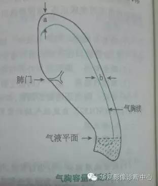 气胸量怎样评估? 气胸量怎样评估?