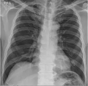 【病例】肺隐球菌病一例CT影像诊断分析 【病例】肺隐球菌病一例CT影像诊断分析