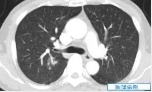 【病例】肺隐球菌病一例CT影像诊断分析 【病例】肺隐球菌病一例CT影像诊断分析