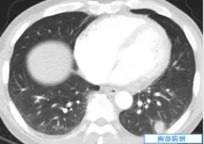 【病例】肺隐球菌病一例CT影像诊断分析