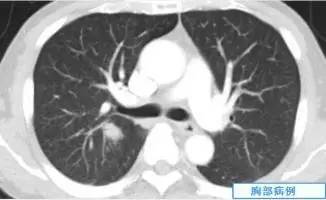 【病例】肺隐球菌病一例CT影像诊断分析 【病例】肺隐球菌病一例CT影像诊断分析