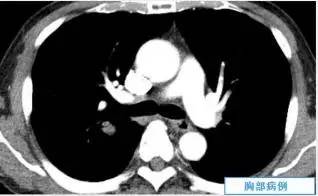 【病例】肺隐球菌病一例CT影像诊断分析 【病例】肺隐球菌病一例CT影像诊断分析