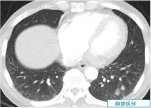 【病例】肺隐球菌病一例CT影像诊断分析 【病例】肺隐球菌病一例CT影像诊断分析