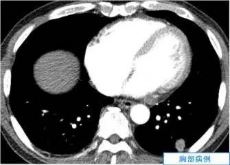 【病例】肺隐球菌病一例CT影像诊断分析 【病例】肺隐球菌病一例CT影像诊断分析