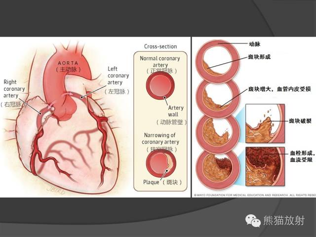 【PPT】冠状动脉斑块评估、管腔狭窄程度分级