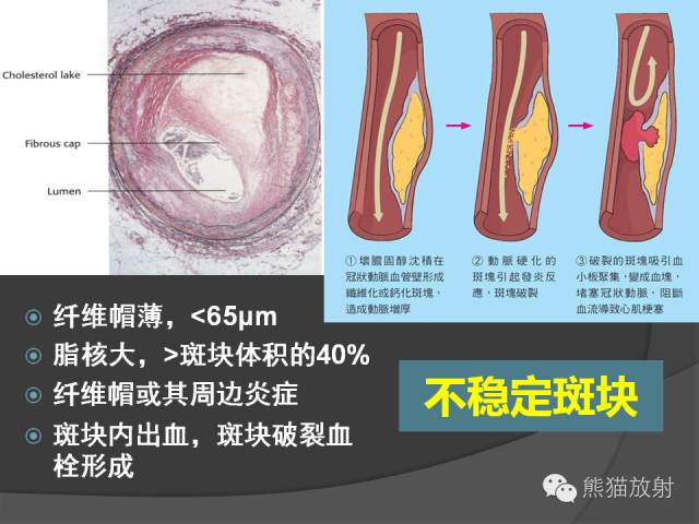 【PPT】冠状动脉斑块评估、管腔狭窄程度分级