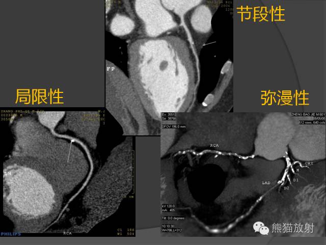 【PPT】冠状动脉斑块评估、管腔狭窄程度分级