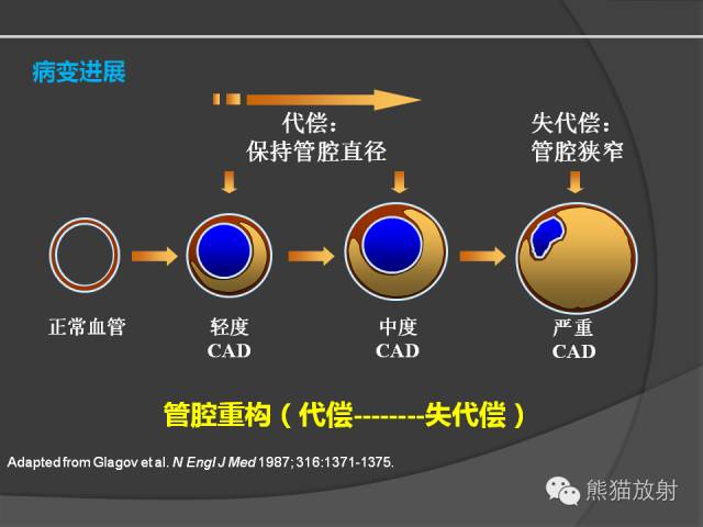 【PPT】冠状动脉斑块评估、管腔狭窄程度分级