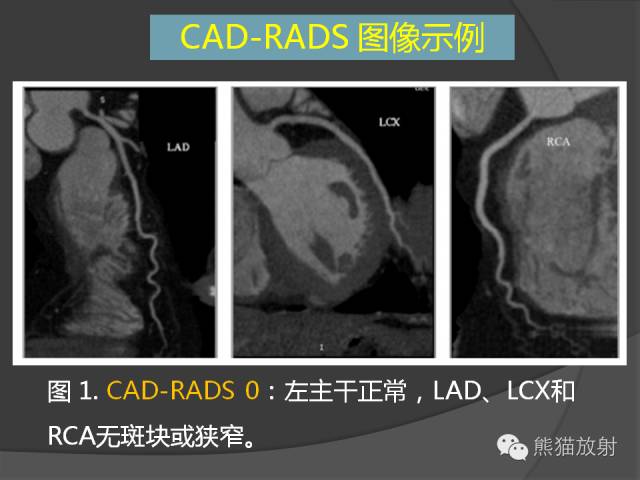 【PPT】冠状动脉斑块评估、管腔狭窄程度分级