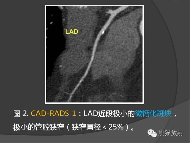 【PPT】冠状动脉斑块评估、管腔狭窄程度分级