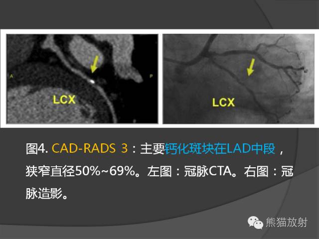 【PPT】冠状动脉斑块评估、管腔狭窄程度分级
