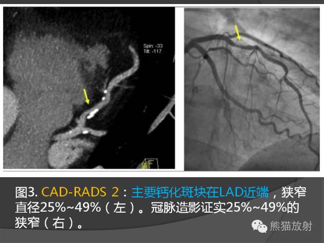 【PPT】冠状动脉斑块评估、管腔狭窄程度分级