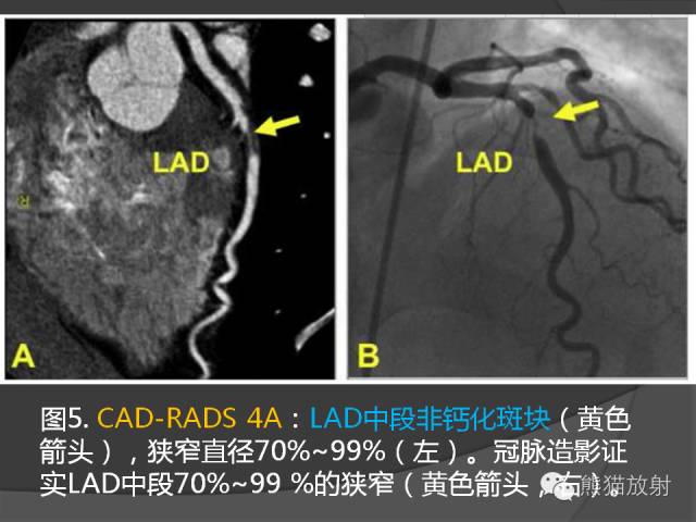 【PPT】冠状动脉斑块评估、管腔狭窄程度分级