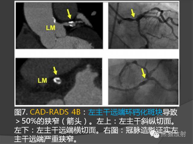【PPT】冠状动脉斑块评估、管腔狭窄程度分级