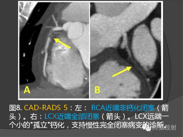 【PPT】冠状动脉斑块评估、管腔狭窄程度分级