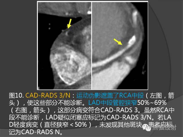 【PPT】冠状动脉斑块评估、管腔狭窄程度分级