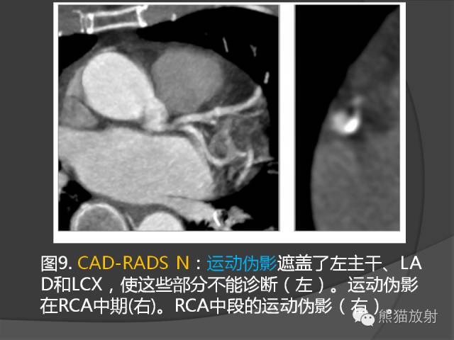 【PPT】冠状动脉斑块评估、管腔狭窄程度分级