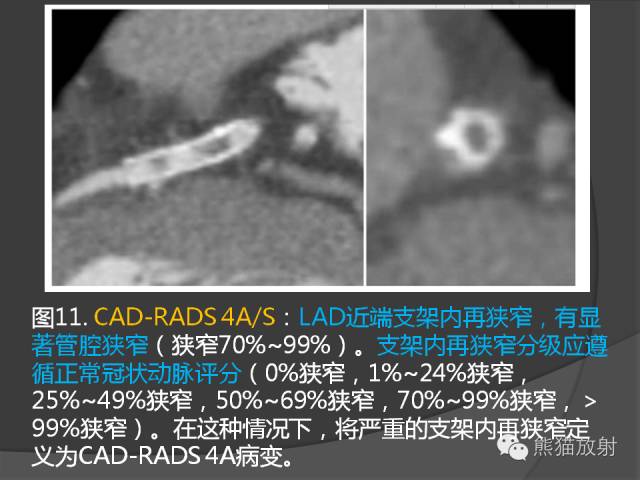 【PPT】冠状动脉斑块评估、管腔狭窄程度分级